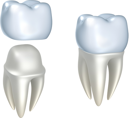 Crowns Inserted in Teeth | Crowns in Newcastle Dental Clinic