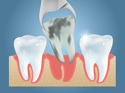 An animation of a dental extraction