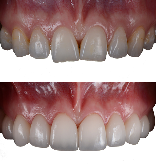 Before and after dental veneers photos of a real patient