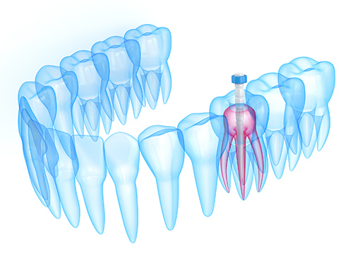 Root Canal Treatment in Newcastle