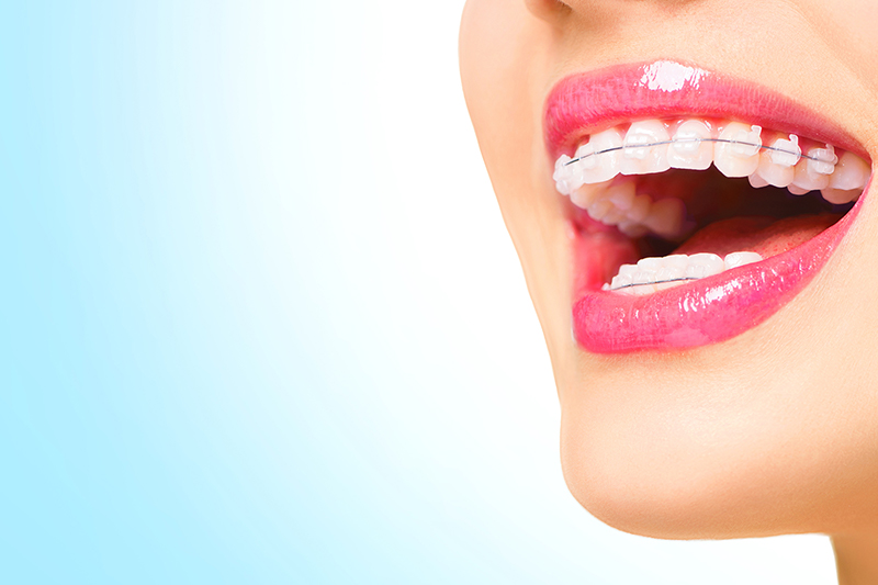 orthodontics-braces-on-teeth