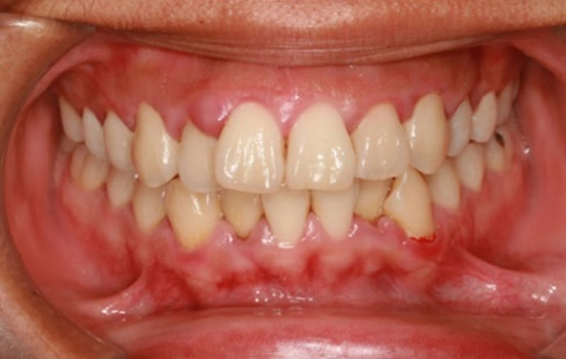 Teeth With Gingivitis