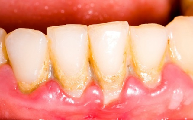 Teeth With Plaque